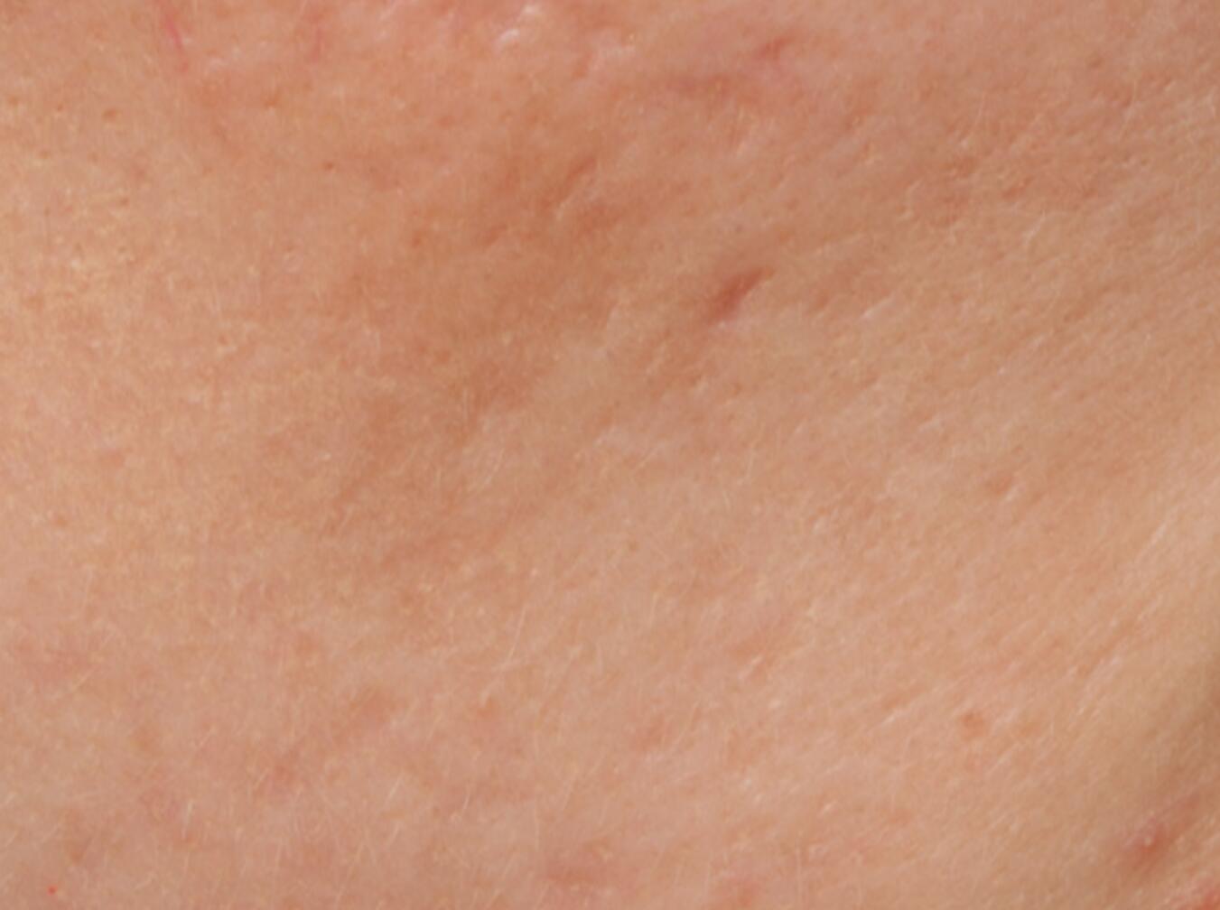 Cicatrices d’acné en boxcar